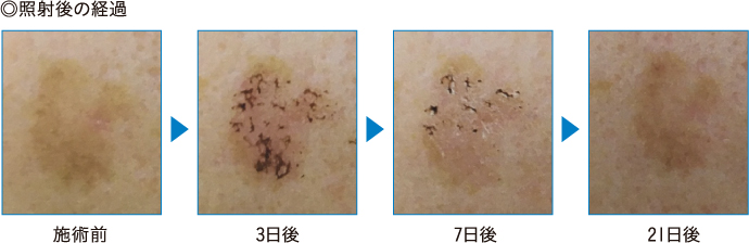 光治療 矢野皮膚科クリニック 香川県高松市の美容皮膚科 美容外科