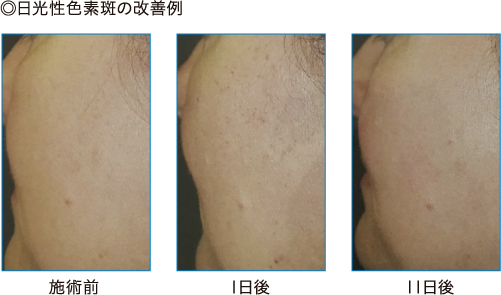 光治療 矢野皮膚科クリニック 香川県高松市の美容皮膚科 美容外科